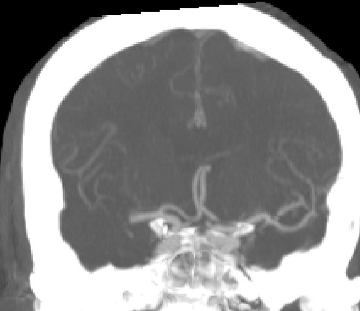 image2-mechanical-thrombectomy-in-double-occlusion-stroke
