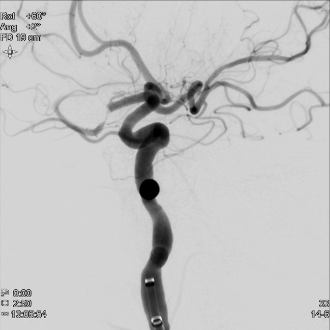 image20-mechanical-thrombectomy-in-double-occlusion-stroke