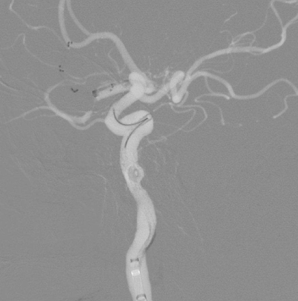 image21-mechanical-thrombectomy-in-double-occlusion-stroke