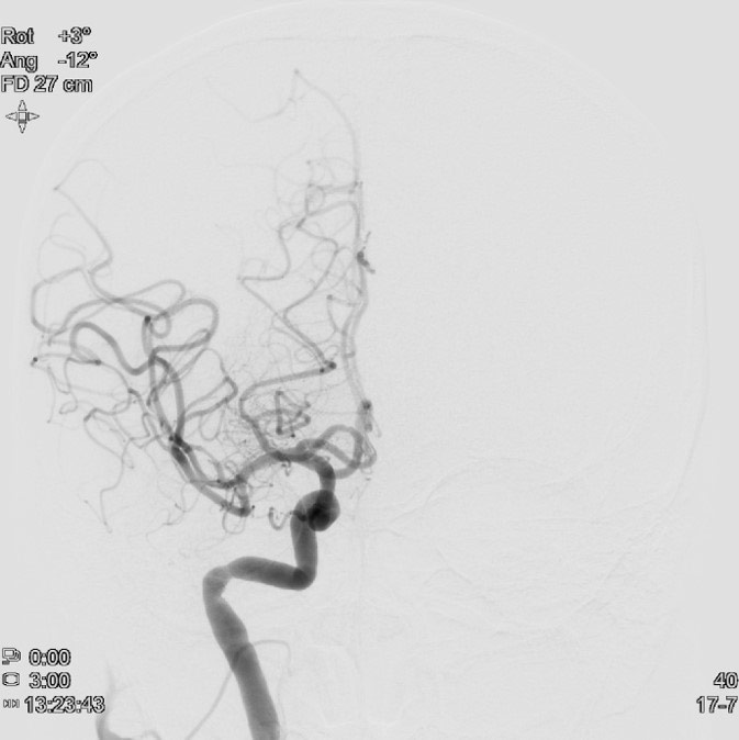 image23-mechanical-thrombectomy-in-double-occlusion-stroke
