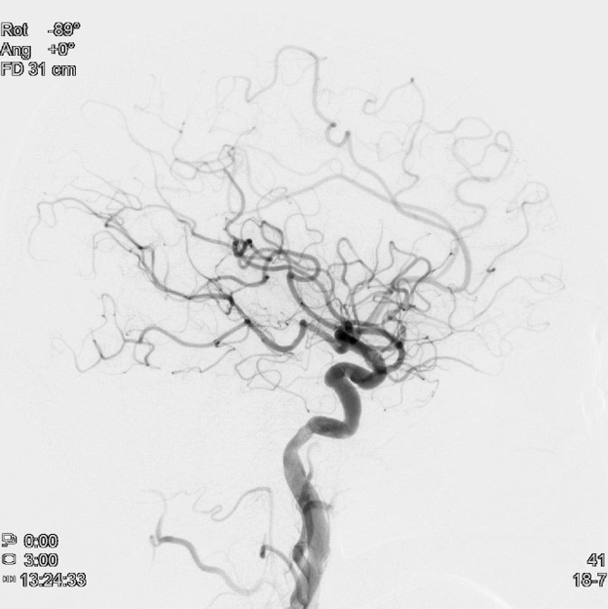 image24-mechanical-thrombectomy-in-double-occlusion-stroke