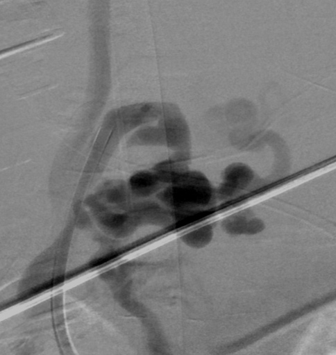 image3-incidental-occlusion-of-right-vertebral-artery-due-to-onyx-digital-subtractial-angiography-spinal-av-fistula-3
