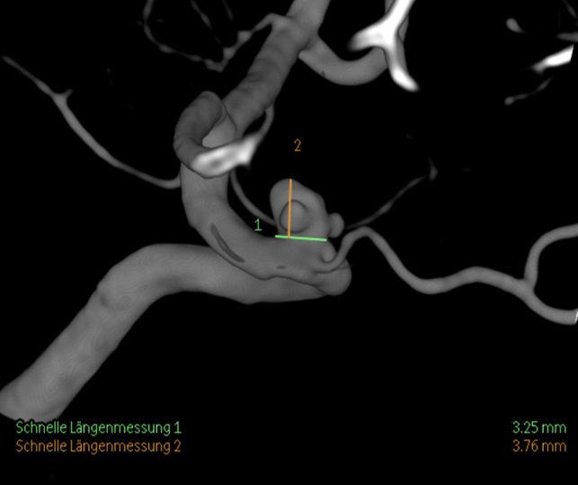 image3-Krug-Intimal-Hyperplasia-parent-vessel-diameter