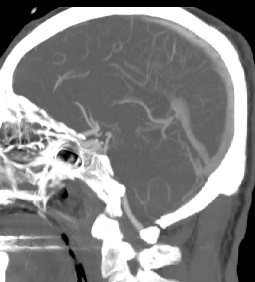 image3-mechanical-thrombectomy-in-double-occlusion-stroke