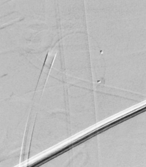 image4-incidental-occlusion-of-right-vertebral-artery-due-to-onyx-6f-catheter-in-vertebral-artery