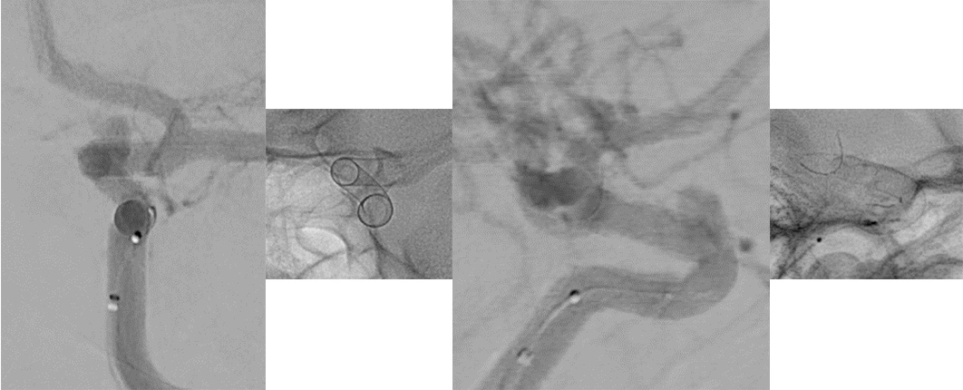 image4-Krug-Intimal-Hyperplasia-treatement-derivo
