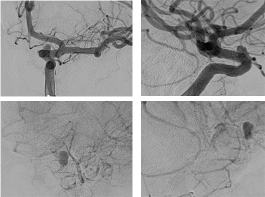 image5-Krug-Intimal-Hyperplasia-postinterventional-dsa