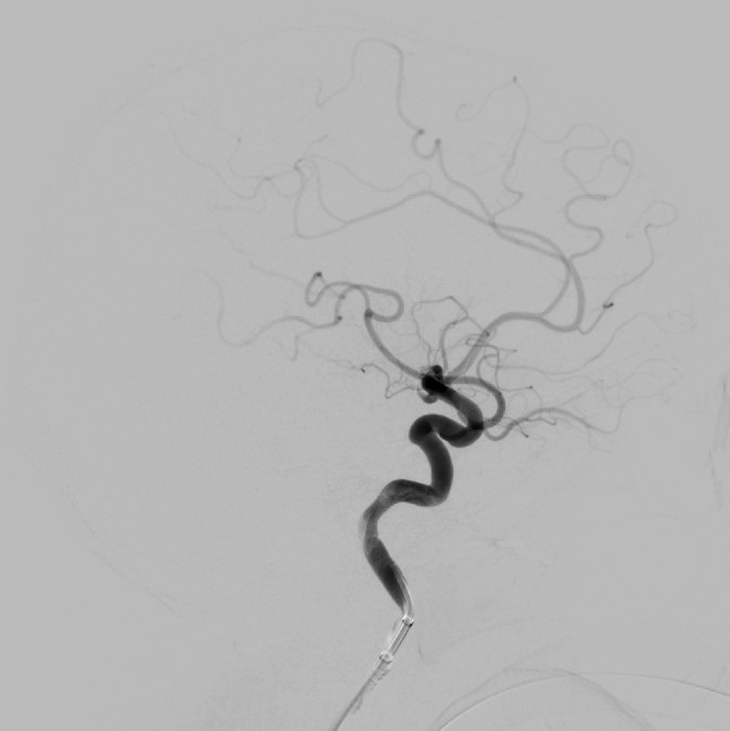 image5-mechanical-thrombectomy-in-double-occlusion-stroke