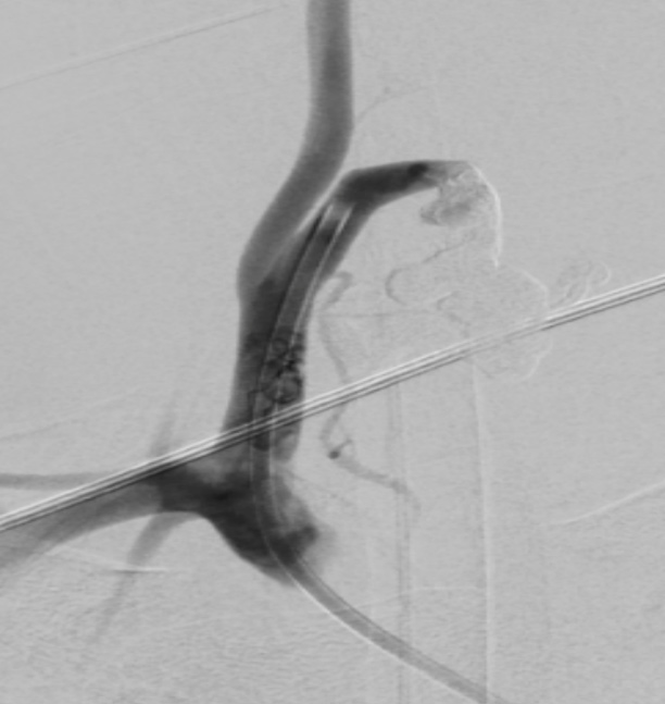 image6-incidental-occlusion-of-right-vertebral-artery-due-to-onyx-succesful-embolization-of-nidus