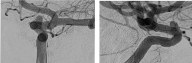 image6-Krug-Intimal-Hyperplasia-post-interventional