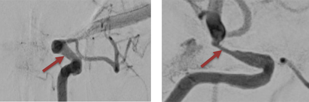 image7-Krug-Intimal-Hyperplasia-post-interventional-7m-fu-no-symptoms