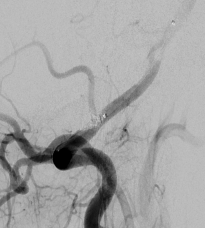 image8-incidental-occlusion-of-right-vertebral-artery-due-to-onyx-remove-onyx-from-vertebral-artery