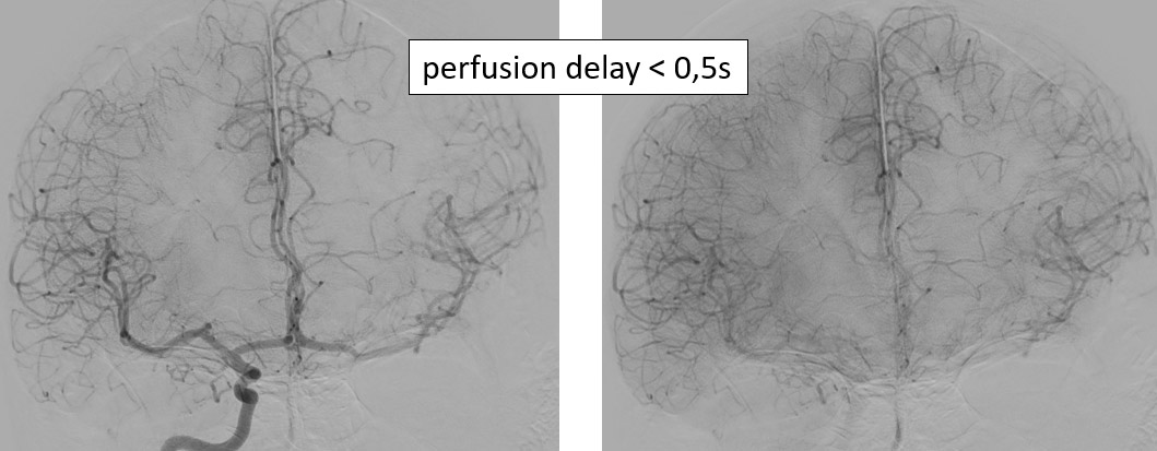 image8-Krug-Intimal-Hyperplasia-interventional-treatment-pta-stent