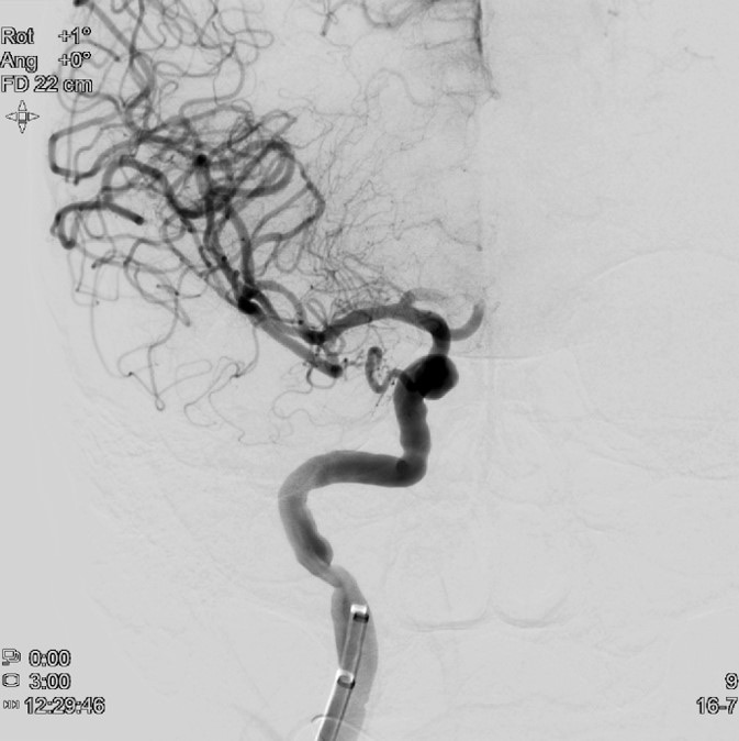 image8-mechanical-thrombectomy-in-double-occlusion-stroke