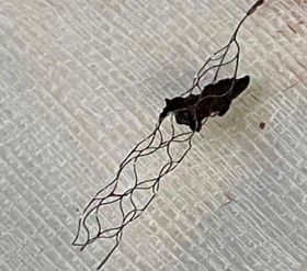 image9-incidental-occlusion-of-right-vertebral-artery-due-to-onyx-onyx-embolus-completly-removed