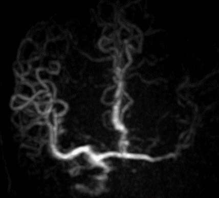 image9-Krug-Intimal-Hyperplasia-supply-of-right-and-stenosed-left-ica