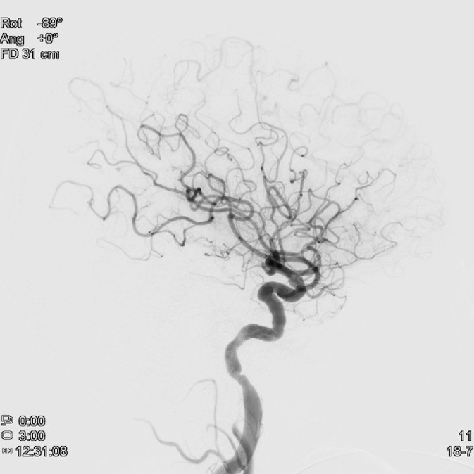 image9-mechanical-thrombectomy-in-double-occlusion-stroke