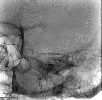 12-intraventricular-hemorrhage-with-a-high-risk-avm-feeder-aneurysm-management-step1