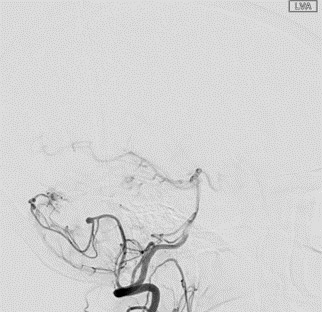 4-intraventricular-hemorrhage-with-a-high-risk-avm-feeder-aneurysm-angiogram-1