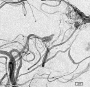 8-intraventricular-hemorrhage-with-a-high-risk-avm-feeder-aneurysm-angiogram-pica-feeder-aneurysm-angiogram-1