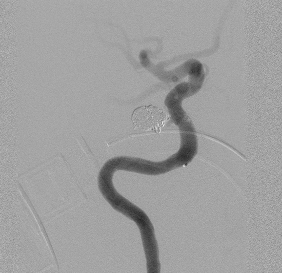 Flow diverter