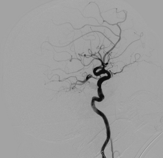 Flow diverter
