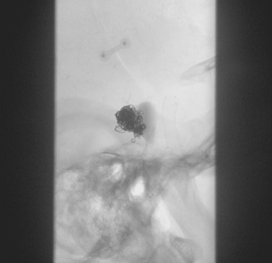 Flow diverter