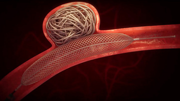 continued parent vessel flow during intrasaccular embolization