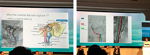 The whole procedure is done through a balloon guiding catheter (BCG) under flow arrest by balloon inflation