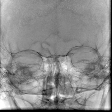 Aspiration cath in front of emboli