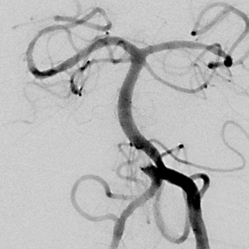 DSA image verifying emboli in right limb of basilar fenestration, also right AICA is not showing