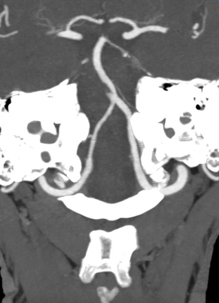 Emboli/clot in right limb of basilar artery fenestration on CT angio
