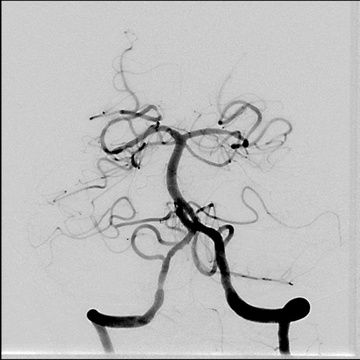 Postproc DSA, TICI 3 revascularisation, with now right AICA present as well.