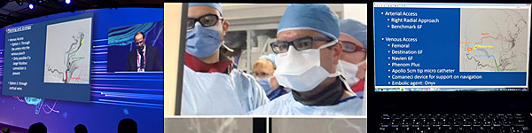 deployment of a very long flow-diverter stent