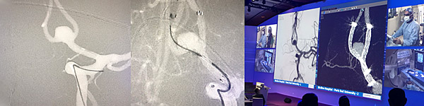 double stenting in a Y-configuration