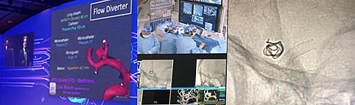 flow-diverter stents for bifurcation aneurysms
