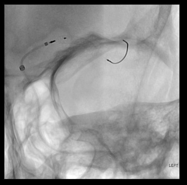 Pipeline-SHIELD-treatment-of-left-anterior-temporal-mid-M1-aneurysm 