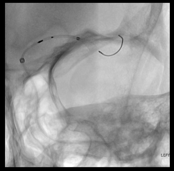 Pipeline-SHIELD-treatment-of-left-anterior-temporal-mid-M1-aneurysm 