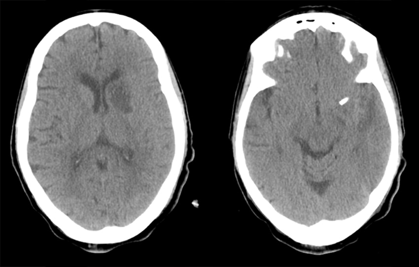 Pipeline-SHIELD-treatment-of-left-anterior-temporal-mid-M1-aneurysm 