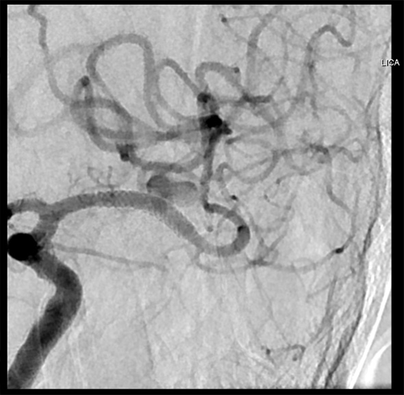 Pipeline-SHIELD-treatment-of-left-anterior-temporal-mid-M1-aneurysm 