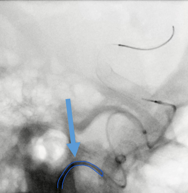 Additional support in the aortic arch with a 0.035” stiff wire in the RIST