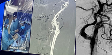 Laurent Spelle continued with a recorded stroke case from Bicêtre Hospital