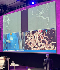 live transmission from Vietnam where a 72-year-old patient with an unruptured pericallosal artery aneurysm