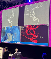 intracranial stenosis of the left internal carotid artery