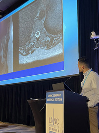 "Combined Transvenous and Transarterial Embolization of Spinal Epidural Venous Fistula" by Dr. Soliman Oushy (USA)