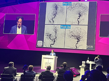 pre-recorded case from Bicêtre Hospital showed the management of a left M1 thrombectomy in a young patient
