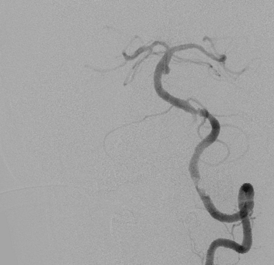 Sidewall basilar trunk aneurysm