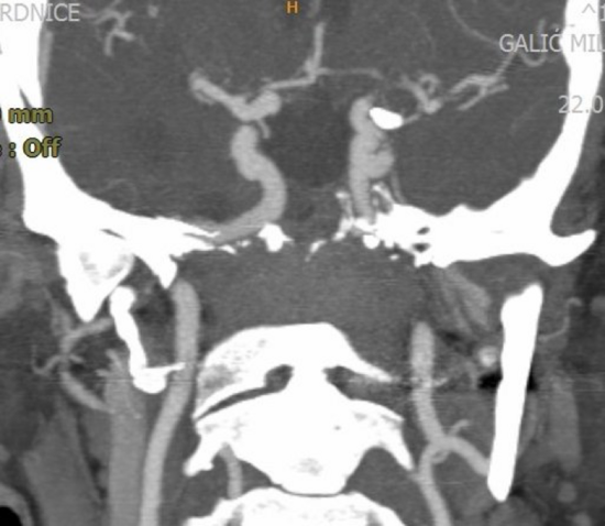 CTA and MRI of pitituary region