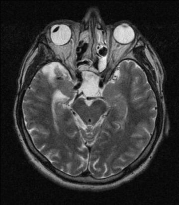 CTA and MRI of pitituary region