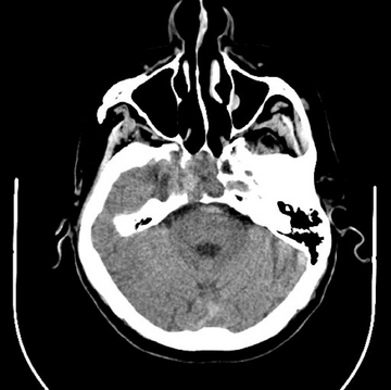 Axial CT